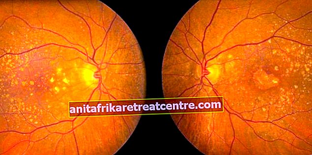 อาการของโรคจุดเหลืองในตาเป็นอย่างไร? สาเหตุของโรคจุดเหลืองทำอย่างไร?