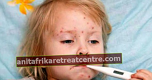 Quali sono i sintomi della varicella?