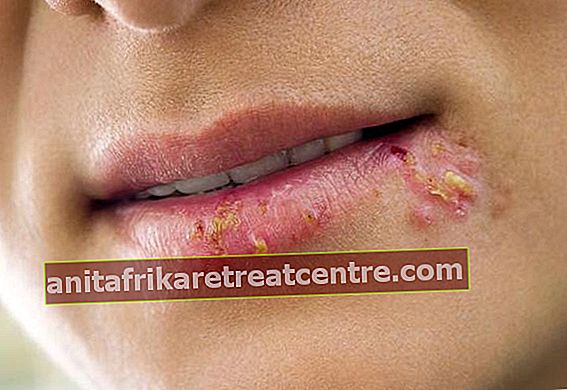 Quali sono le cause dell'herpes labiale? Come si ottiene l'herpes labiale?