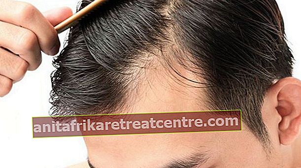 Quali sono le cause della caduta dei capelli? Quali misure dovrebbero essere prese per la caduta dei capelli?
