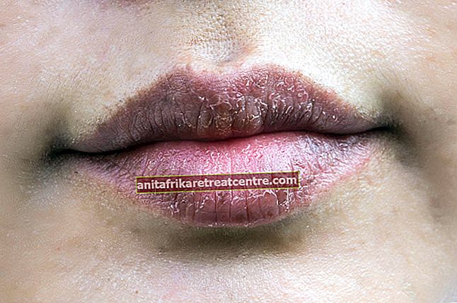Come passa la crosta sulle labbra? Consiglio contro le labbra secche