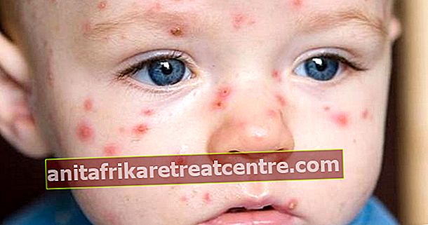 Come viene trattata la varicella?